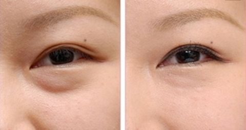 成都李烈療法注脂面部效果令人驚嘆！實(shí)例揭秘