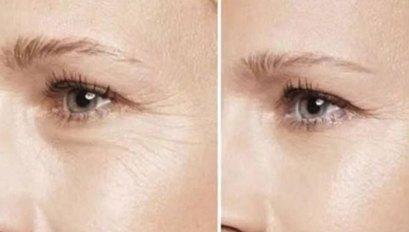 徐州二院哪位醫(yī)師擅長雙眼皮手術(shù)？權(quán)威推薦榜單+手術(shù)費(fèi)用明細(xì)參考