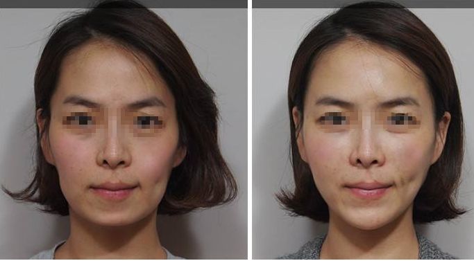 深圳頂級(jí)乳房整形專家團(tuán)隊(duì)？權(quán)威醫(yī)院解答哪家三甲醫(yī)院最適合隆胸