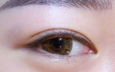 鄒翀，這一雙眼皮技術(shù)，近期有所革新