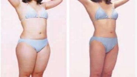 自體脂肪豐胸手術(shù)的副作用及不良反應(yīng)有何？