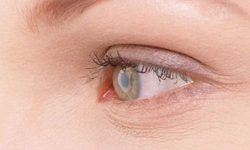 航空院眼袋手術(shù)效果如何？最新案例分享