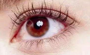 浙江醫(yī)院范希玲雙眼皮手術(shù)費用2023年新浮現(xiàn)，消費者案例分享