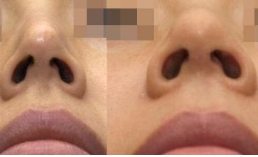 南寧整形醫(yī)院治療疤痕效果如何？最佳選擇揭秘