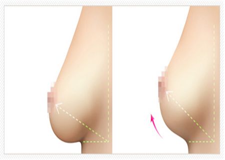 哈爾濱醫(yī)大一院乳房隆胸技藝揭秘！最新案例驚艷發(fā)布