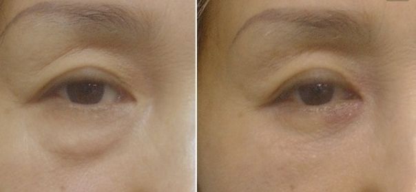 北京八大處趙延勇醫(yī)生的雙眼皮手術(shù)如何？了解醫(yī)院背景和手術(shù)案例。