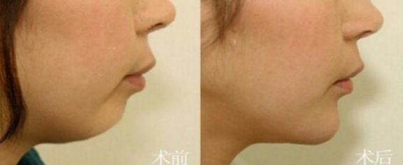 成都這7家專業(yè)豐胸醫(yī)院，不可錯過的排名第一