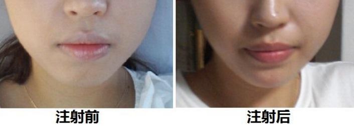 廣州豐胸手術(shù)那家靠譜？最新推薦！整形技術(shù)、價(jià)格醫(yī)生保駕護(hù)航