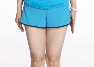 口碑醫(yī)師揭秘｜2023年易陽艷割雙眼皮價格曝光