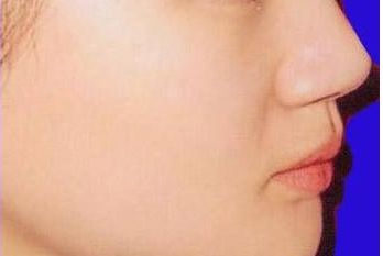 南京施爾美劉衛(wèi)豐鼻匠：獨(dú)具實力，成功案例揭秘！