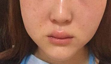 廣州美恩顧榮雙眼皮手術經(jīng)驗分享：90天親測案例展示