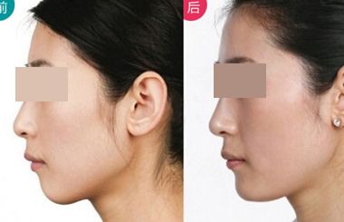 上海哪個醫(yī)生擅長鼻翼縮小？2023年度網民口碑推薦醫(yī)生名冊曝光