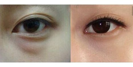 羅日云整容醫(yī)生的服務(wù)及費(fèi)用詳情，隱私公開(kāi)！優(yōu)質(zhì)雙眼皮案例與收費(fèi)一覽供參考！