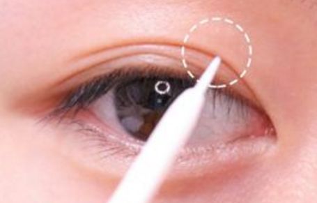 北京美聯(lián)臣路世敏醫(yī)生幫你告別歲月痕跡！除皺案例分享！