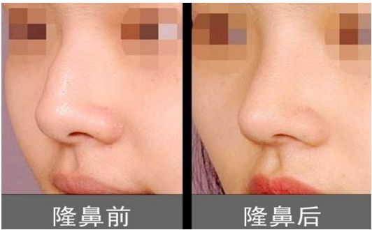 上海柴云醫(yī)生雙眼整形效果完美！手術(shù)前后真實(shí)照片呈現(xiàn)出專業(yè)水平