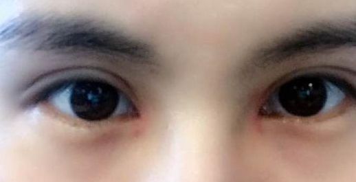 張盈帆雙眼皮手術(shù)費(fèi)用評估！專家點(diǎn)評及最新報價公布！