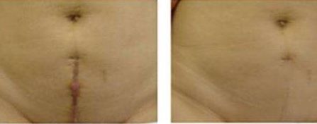 重慶張恒術(shù)進(jìn)行雙眼皮手術(shù)，醫(yī)生實(shí)力以及成功案例展示