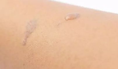 整形醫(yī)生楊小順在鄭州陽(yáng)光創(chuàng)美進(jìn)行眼部手術(shù)口碑如何？