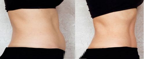 英諾小棕瓶的微針和滾針，如何選擇？英諾小棕瓶反黑效果需要多久呢？