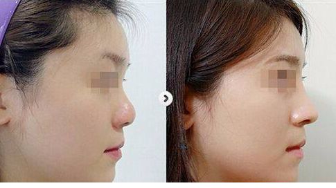 揭秘廣州整容界很受推崇的隆鼻醫(yī)生排行榜！TOP10豪華陣容對決，尊貴專家非一般醫(yī)師！