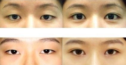 北京首家細致公正：觸手可及的雙眼皮整形醫(yī)生排名初現(xiàn)時！