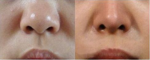 南京哪個醫(yī)生擅長縮胸手術(shù)？評價吳國平和金院長的技術(shù)