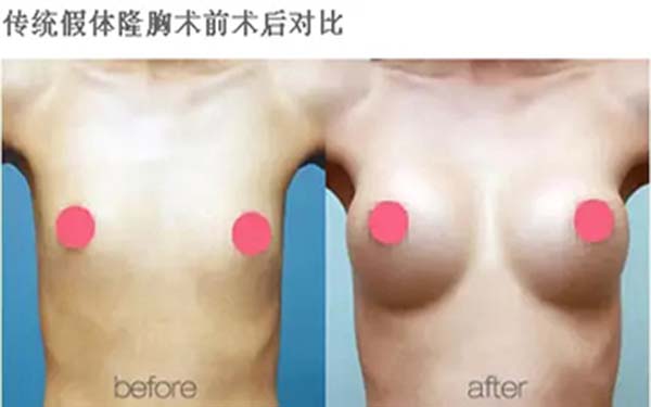 首選，你想知道成都素美脂肪填充的表現(xiàn)如何？！其次，成都素美脂肪填充的效果如何呢？