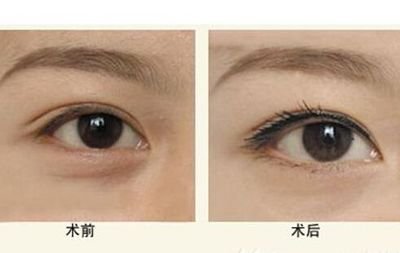 嘉興哪家醫(yī)院可以消除木偶紋效果好？