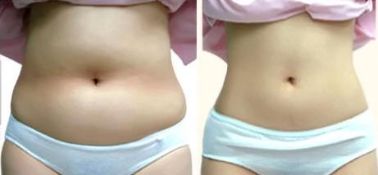 成都最佳面部吸脂醫(yī)生排名揭曉！八大靠譜醫(yī)生名單引爆話題！