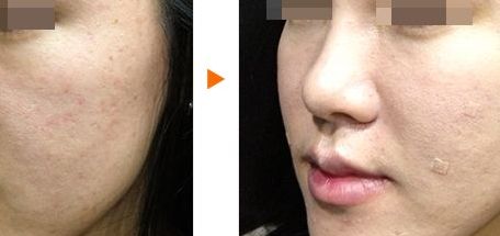 臨安芘麗芙整形醫(yī)院聯(lián)系方式及鼻部整形效果分享