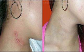 北京首都整形醫(yī)院雙眼皮修復(fù)效果如何？詳細(xì)案例揭秘