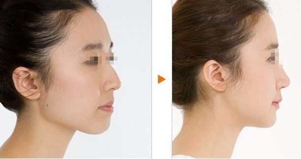 沈陽隆胸整形哪家醫(yī)院技術(shù)領(lǐng)先？頭部醫(yī)療機構(gòu)推崇，專業(yè)醫(yī)生幫您圓夢