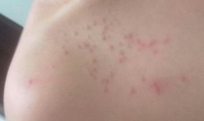 北京萬達(dá)行姜洪濤醫(yī)生最新開眼角效果分享！2023年價(jià)格公布！