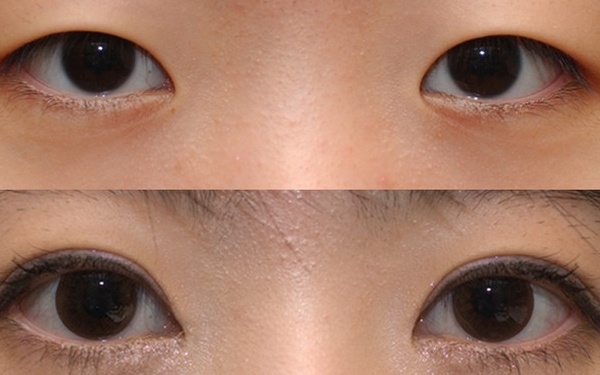 上海哪家醫(yī)院做眼袋手術(shù)價(jià)格實(shí)惠又靠譜？排行榜前十強(qiáng)！