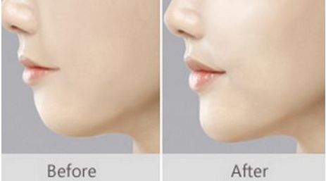 上海唇裂修復(fù)的五家知名醫(yī)院，人氣爆棚，不容錯(cuò)過(guò)！