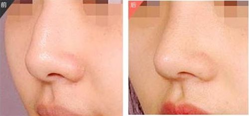 田孝臣醫(yī)生的鼻部整形效果如何？?jī)r(jià)格如何？技術(shù)評(píng)價(jià)+成功案例解析