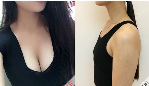 安醫(yī)大一附院整形外科推薦醫(yī)生，自體脂肪隆胸效果好