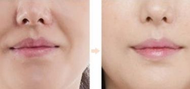 南京華韓奇致醫(yī)生解答：如何進行眼睛手術？2023真實案例發(fā)布