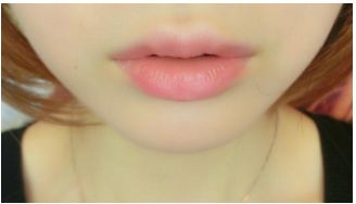 年齡段選擇，雙眼皮手術(shù)何時較適宜