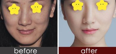 有效消腫的雙眼皮修復(fù)技巧由經(jīng)驗(yàn)豐富的整形醫(yī)生分享