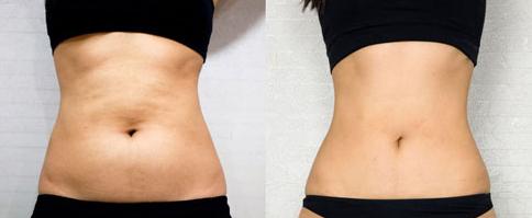 延安醫(yī)院隆胸效果如何？哪位專家值得信賴？