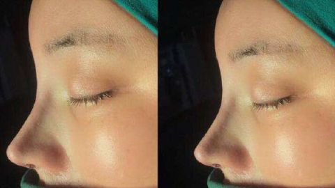 最佳2023西安雙眼皮修復(fù)醫(yī)生推薦！宋保強(qiáng)、馬顯杰好評(píng)如潮，立即預(yù)約！