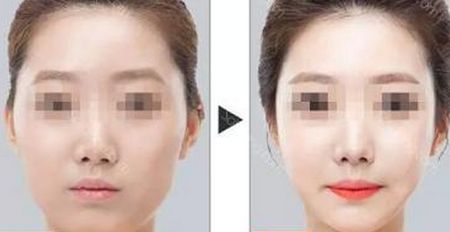 石家莊最受歡迎的除皺美容醫(yī)院排名榜前六來襲！2023年超贊抗衰除皺全攻略！