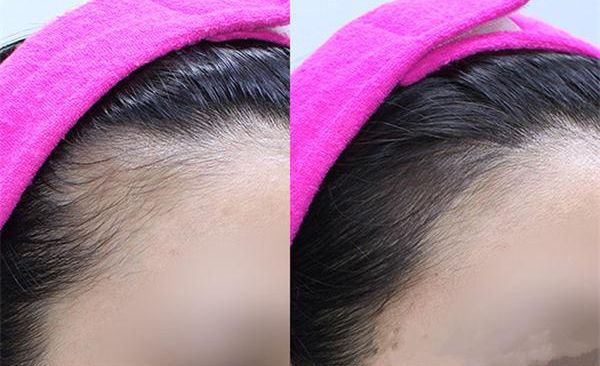 鄭州哪家醫(yī)院擅長(zhǎng)祛斑，技術(shù)精湛值得推薦！