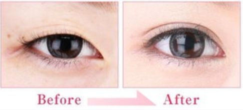 合肥哪家醫(yī)院的隆鼻效果好？技術(shù)過硬嗎？