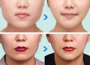 杭州哪家醫(yī)院做下頜角整形效果好？綜合口碑、價格受好評的幾家醫(yī)院推薦