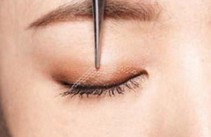鄭州賈亮眼部整形技術(shù)介紹，修復(fù)雙眼皮效果如何？成功案例披露