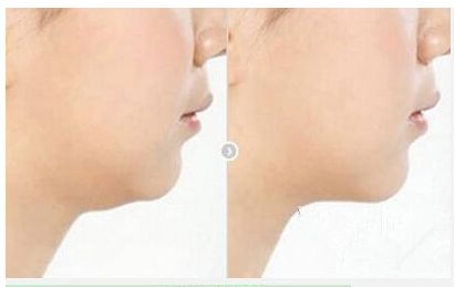 高偉的頜骨修復(fù)費(fèi)用及綜合實(shí)力揭秘，醫(yī)生專業(yè)解讀技術(shù)及真實(shí)案例分享