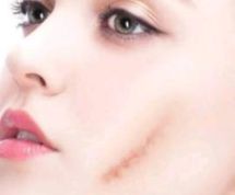 護(hù)膚新寵——玻尿酸填充細(xì)紋秘籍