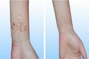 蘇州哪家醫(yī)院適合做雙眼皮修復(fù)手術(shù)？眼部整形修復(fù)有哪些選擇？